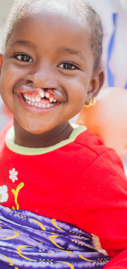 Awa, five-year-old African girl with cleft lip before surgery on Mercy Ships Life Boat