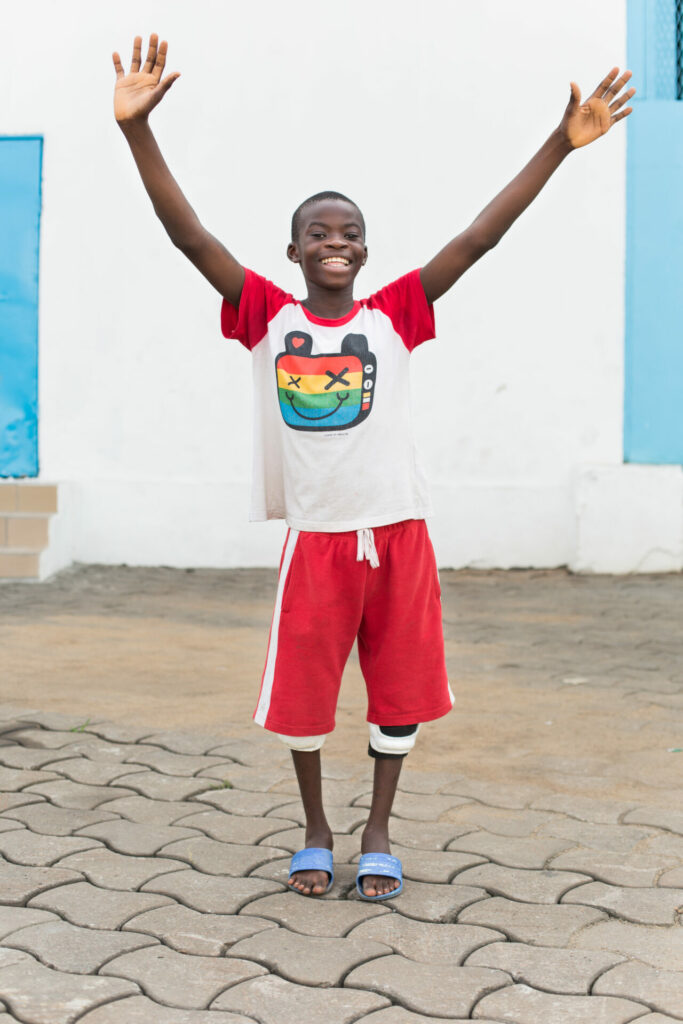 Ulrich - a boy who previously had very bent legs - stands on his newly straightened legs. Photo: Mercy Ships