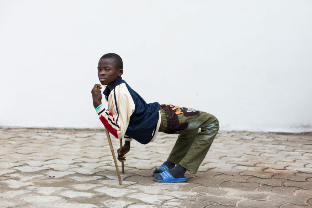 Ulrich, an orthopedic patient with legs bent backwards, before surgery. Photo: Mercy Ships 