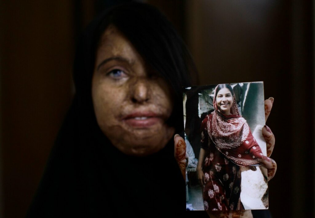 acid attack survivor naila farhat 