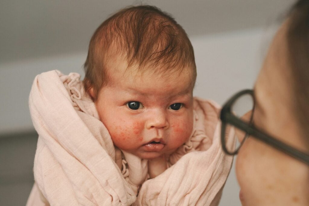 Mother holding wrapped newborn baby with a rash on their face