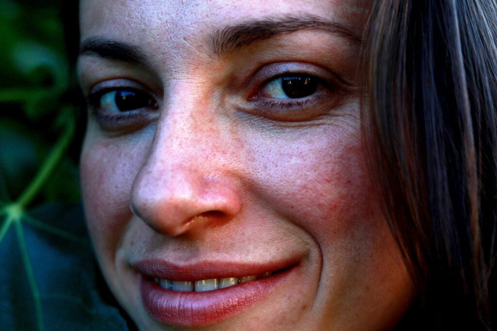 Lady with skin burnout smiling to camera with leaves behind her 